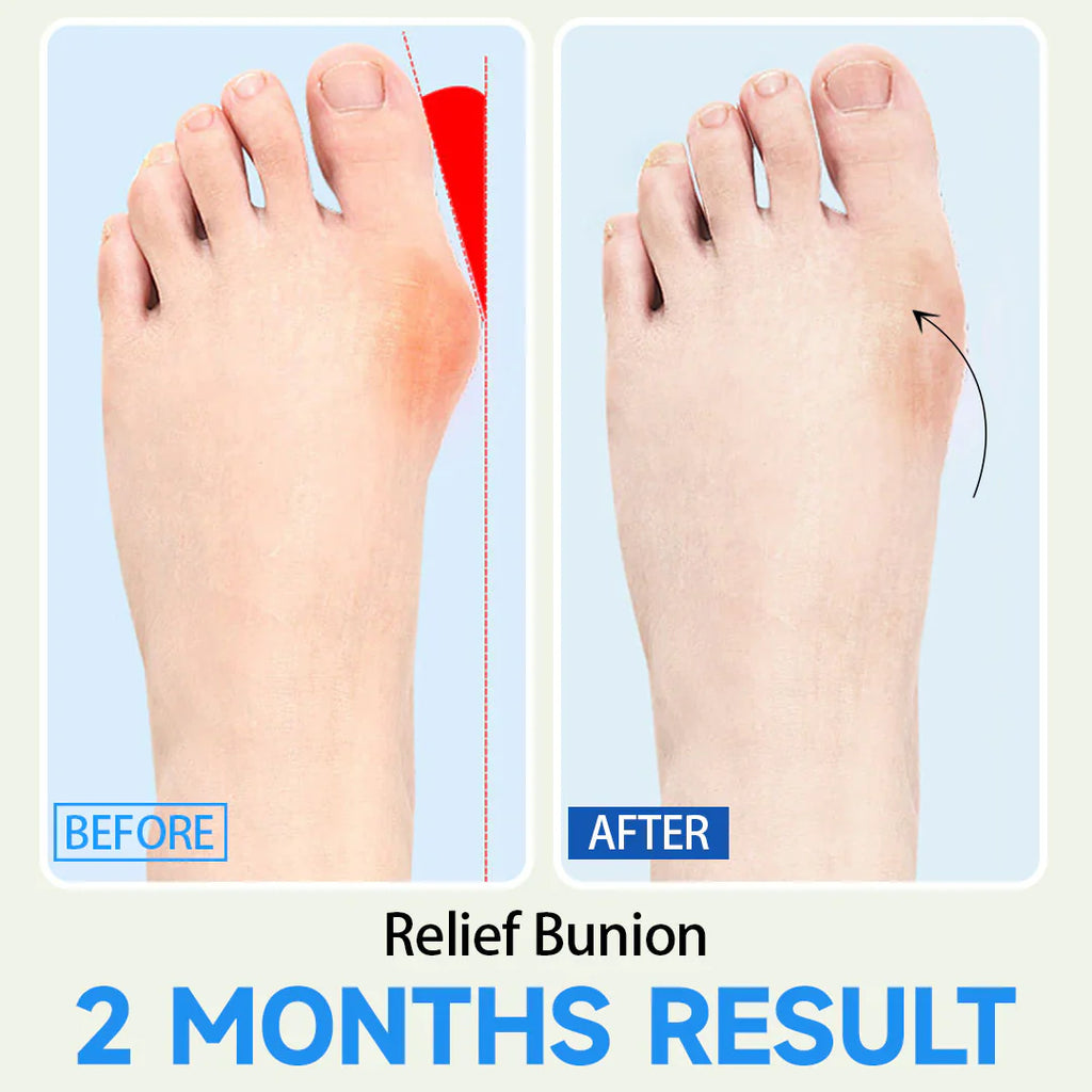 Bunion Corrector 2.0