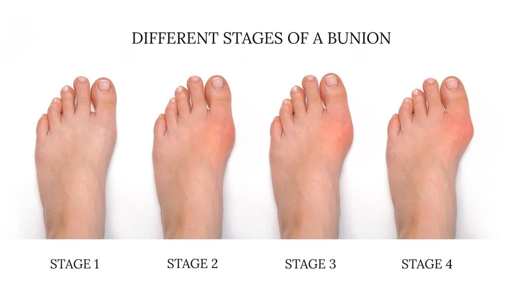 Bunion Corrector 2.0