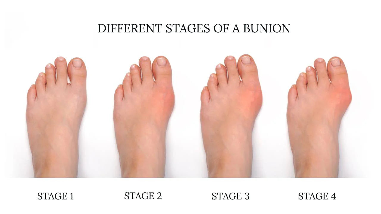 Bunion Corrector 2.0